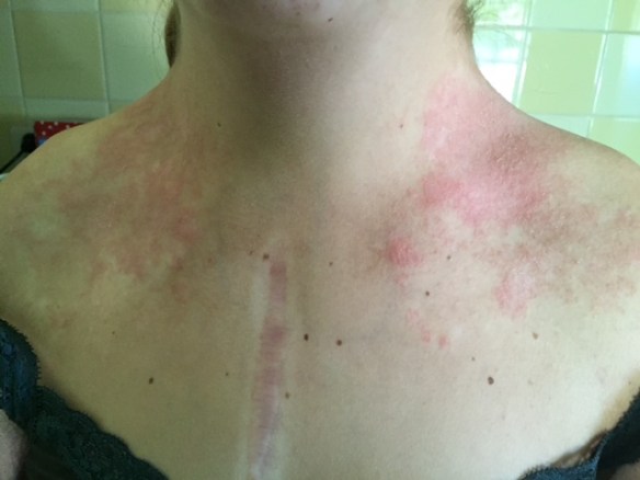 Emma haar nek en hals zit onder de uitslag..en het jeukt ontzettend..!