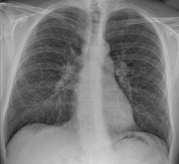 Chest_X-ray_of_sarcoidosis_nodules.png